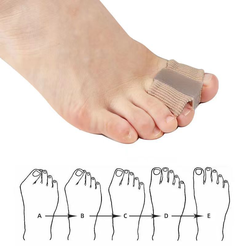 Orthopedic Fiber Toe Separator